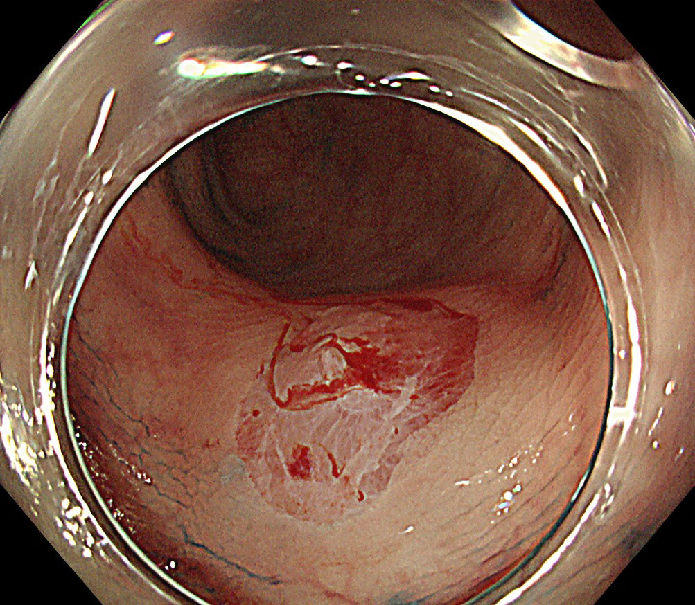 大腸cold polypectomy