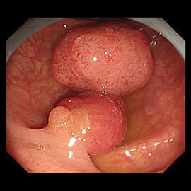 並んだ大きなサイズのポリープ