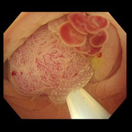 病変を浮き上がらせてスネアで絞扼病変①