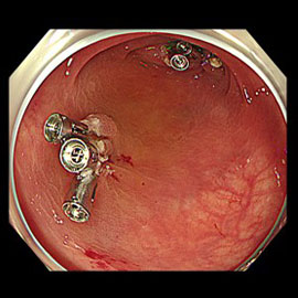 切除後クリップで縫縮して終了