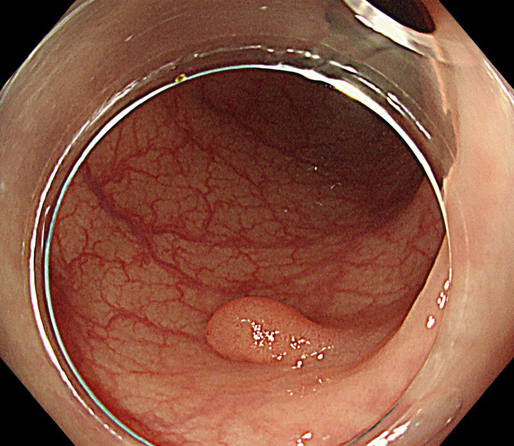 大腸cold polypectomy